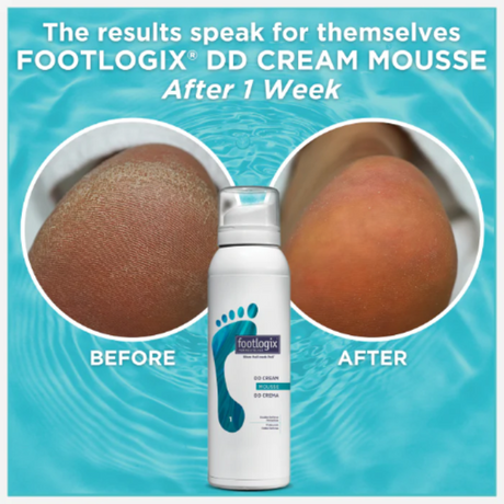 Footlogix® DD Double Defense Cream Mousse for Dry Skin