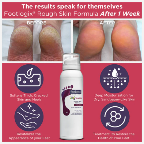 Footlogix® Cream Mousse Rough Skin Formula