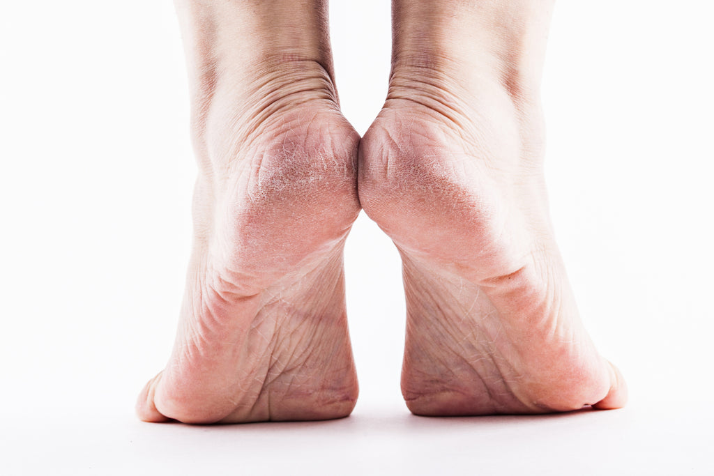 Dry Skin or Athlete's Foot? How to spot the difference.